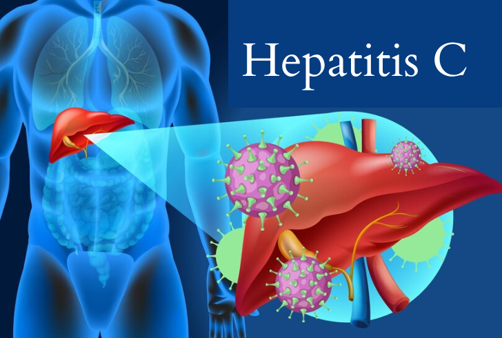 Today, more than 95 percent of Hepatitis C cases can be cured with a simple daily pill